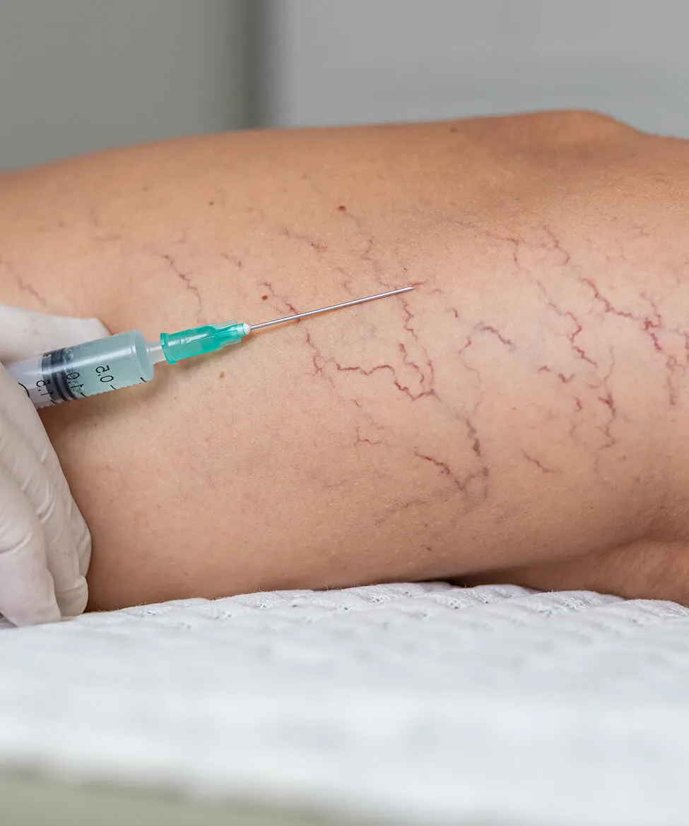 Sclerotherapy