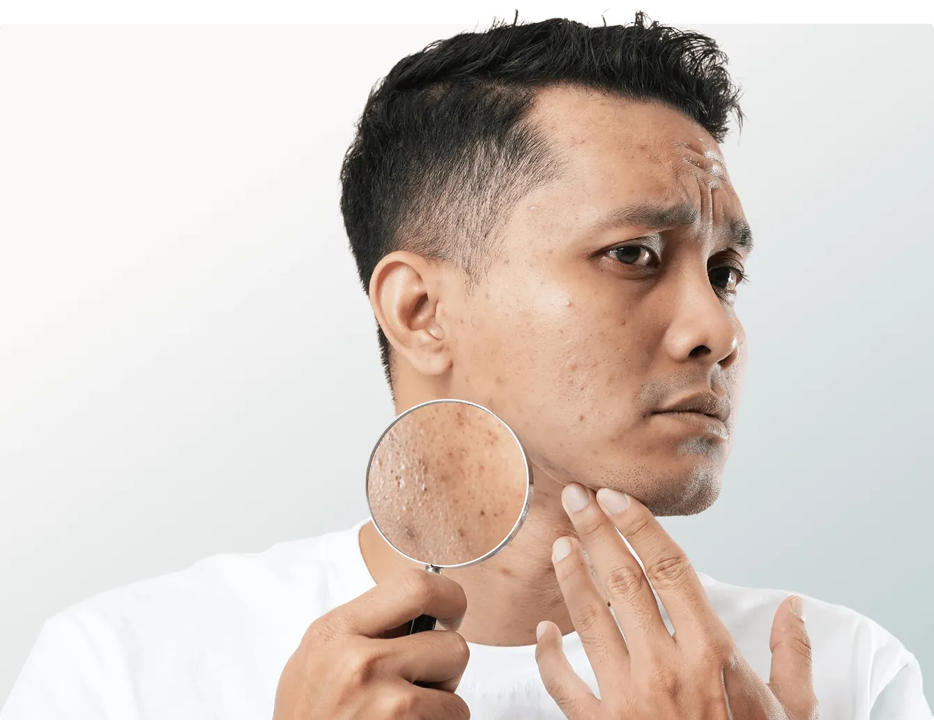 Acne scars