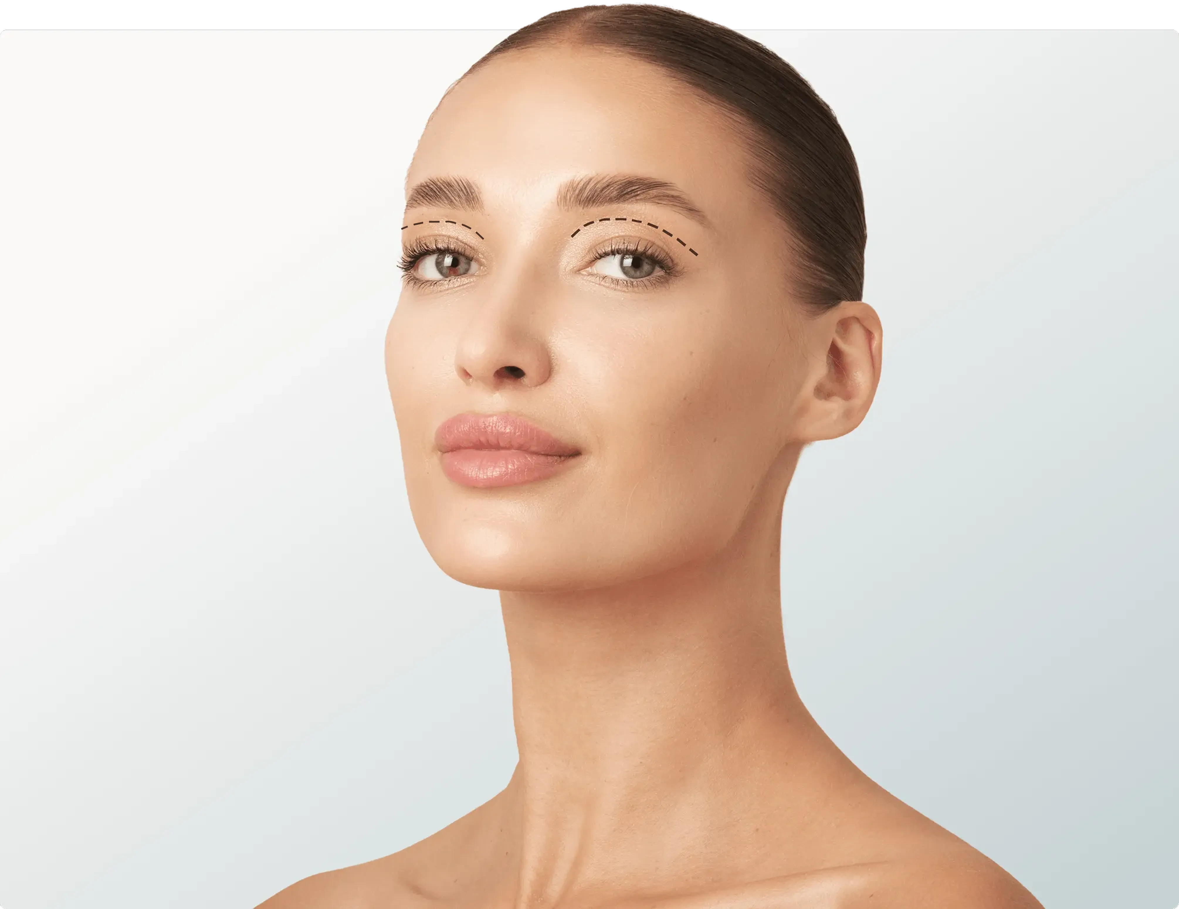 Upper Blepharoplasty