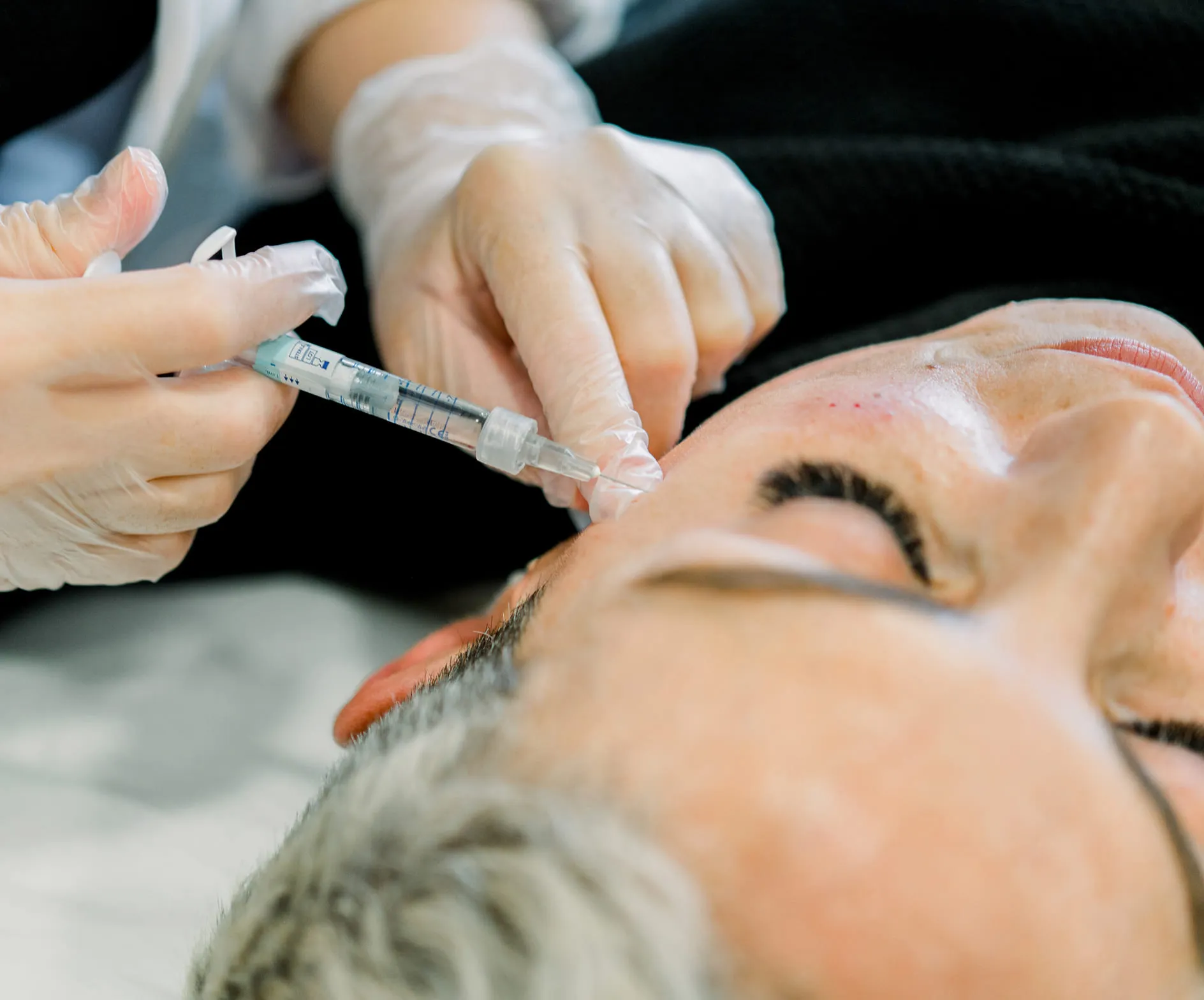 Dermal Fillers