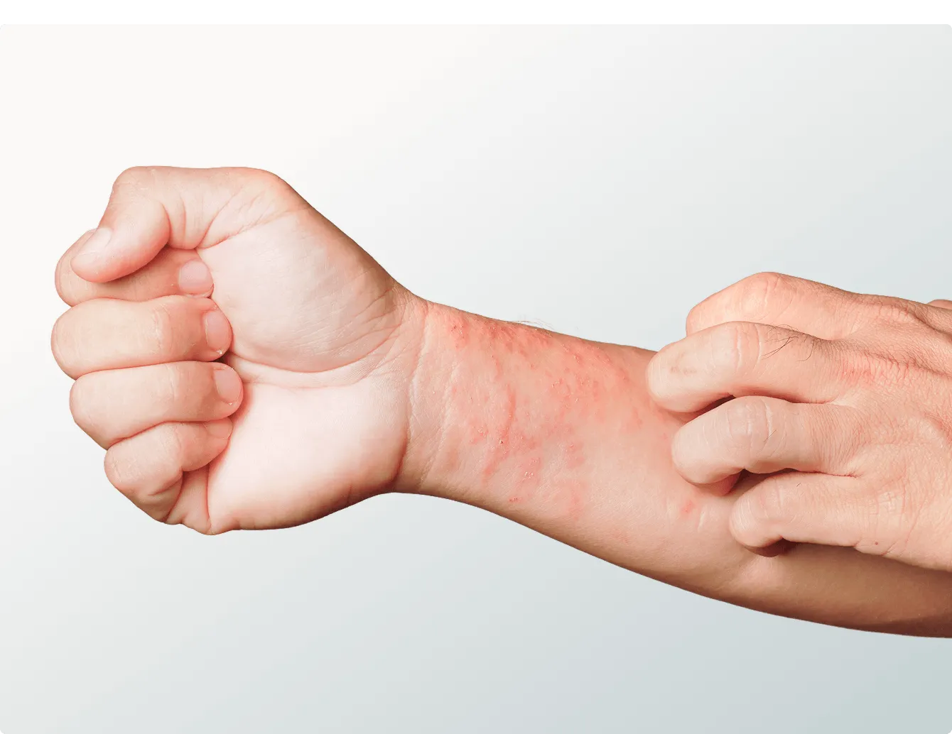 Eczema