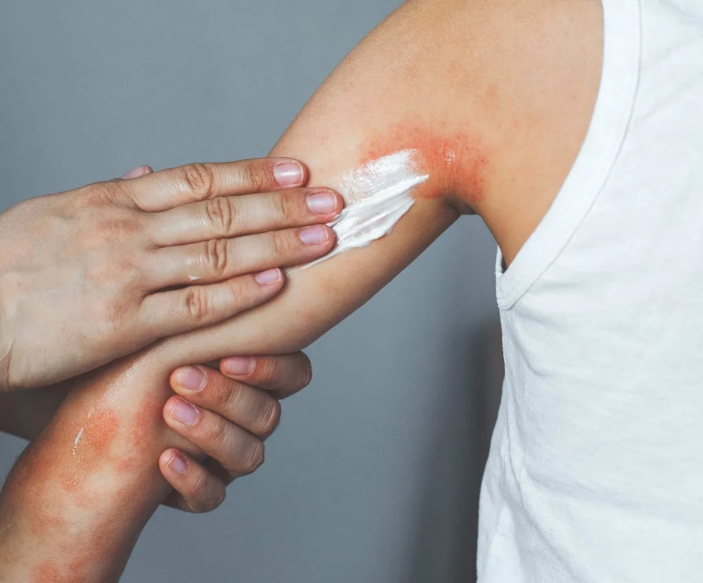 Personalized treatment options for eczema