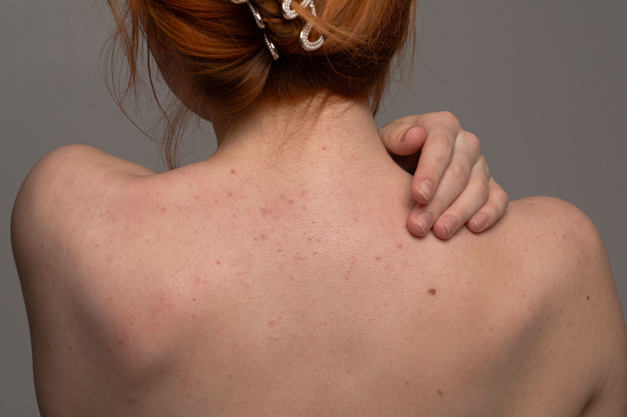 How to Care for Your Skin After a Skin Cancer Excision