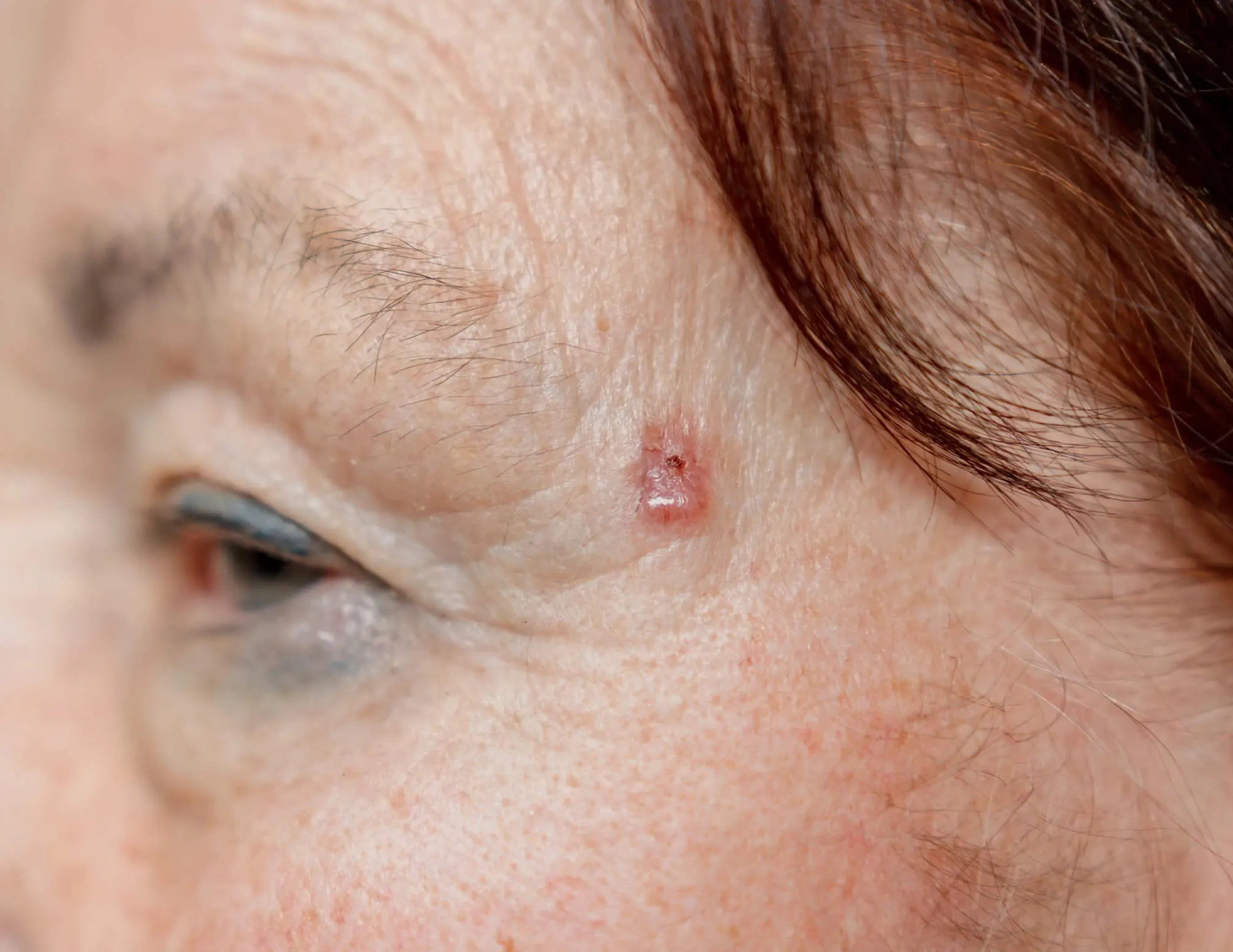 Mohs surgery