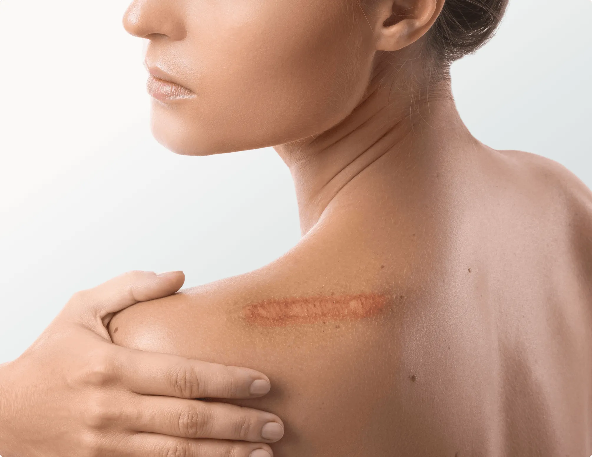 Scar Revision