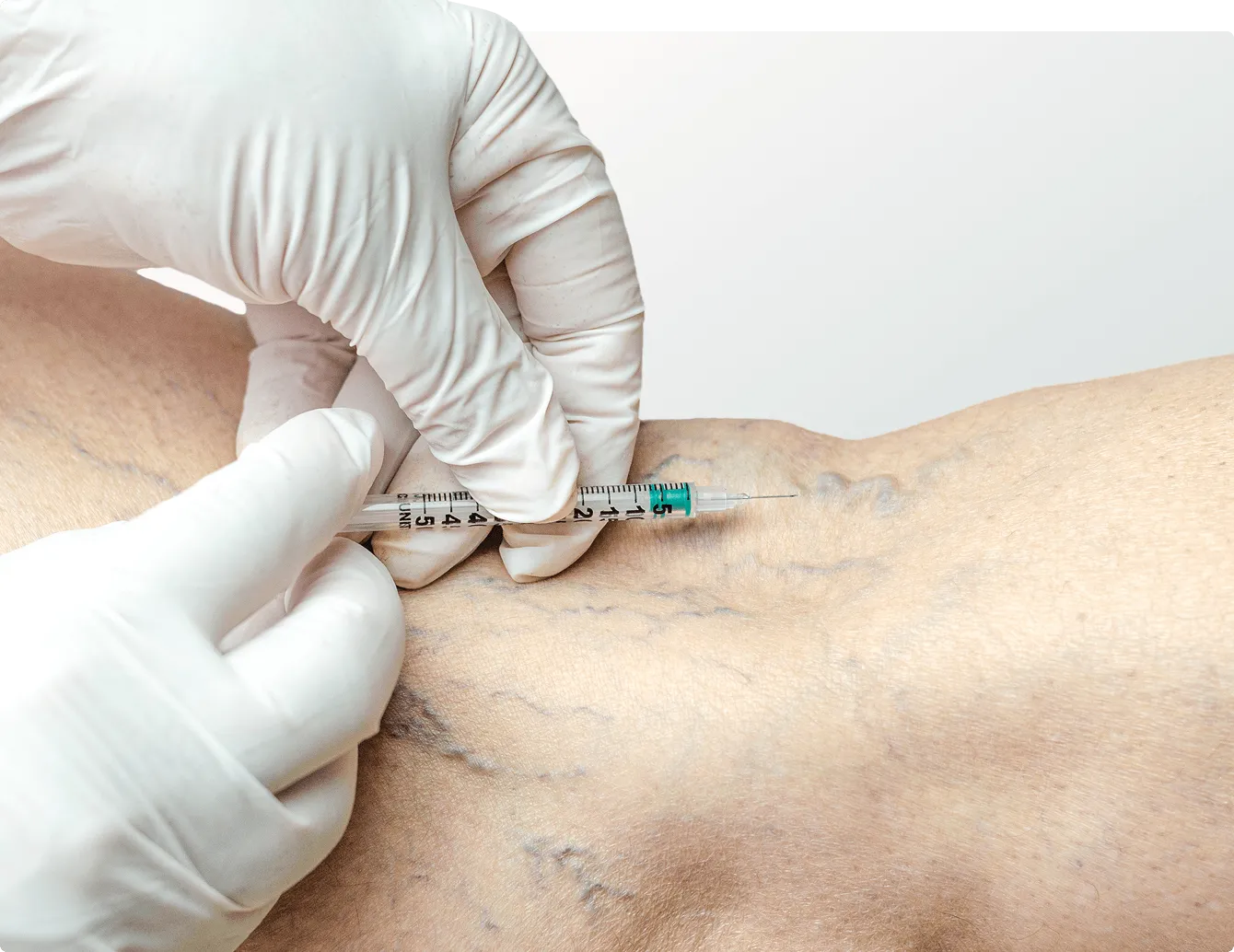 Sclerotherapy