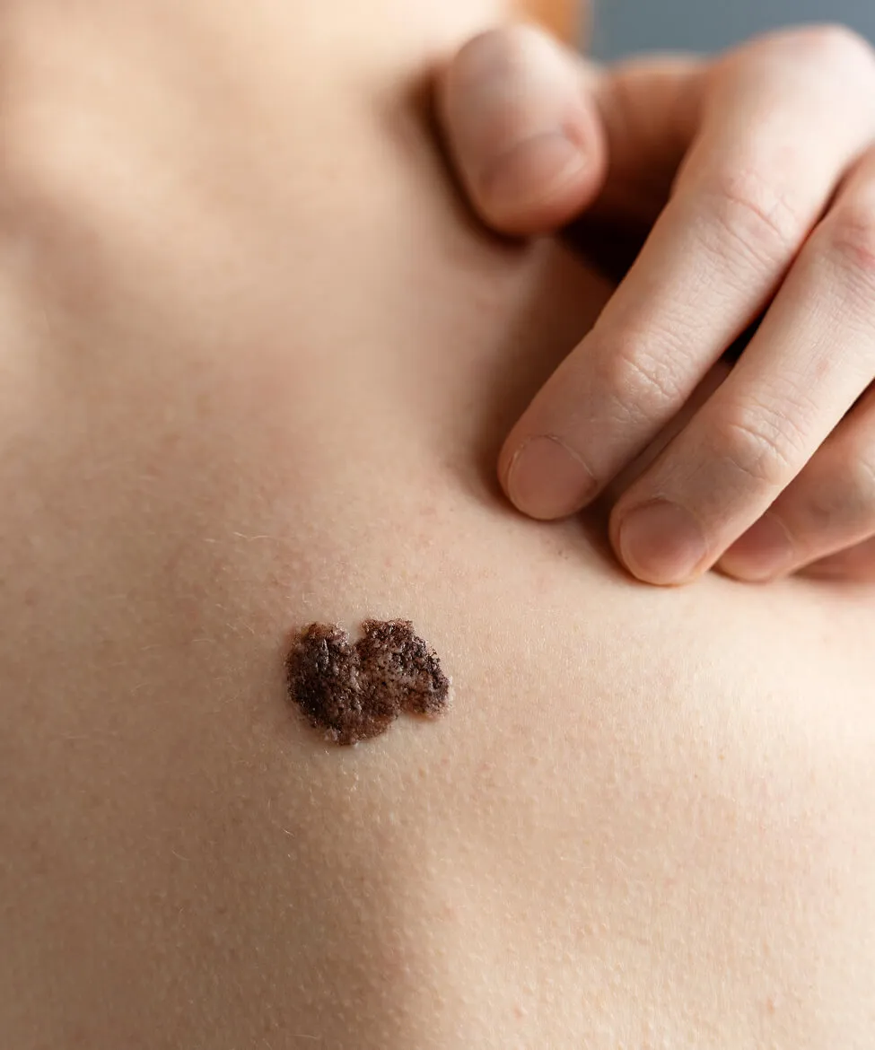 Moles and unwanted lesions