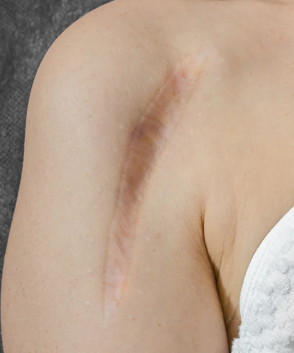 Scar revision