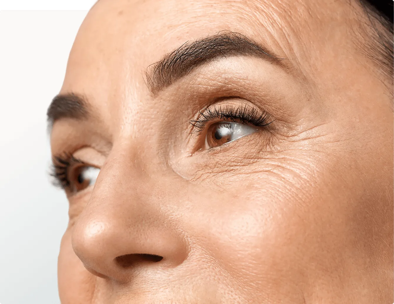 Wrinkles and smoker's lines