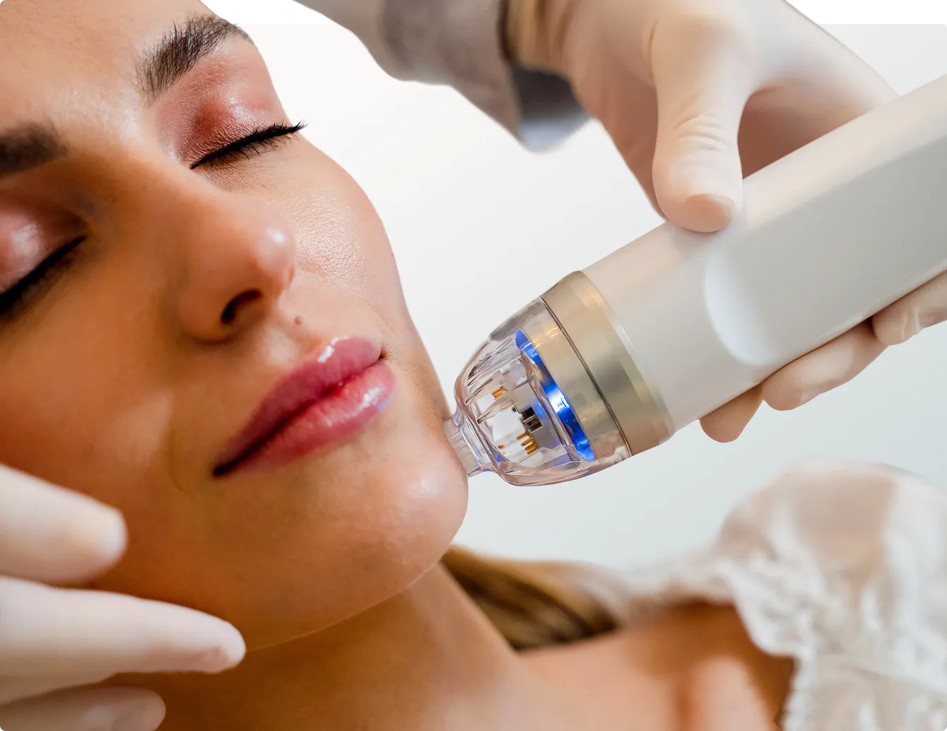 XERF™ at New Wave Dermatology in Newport Beach