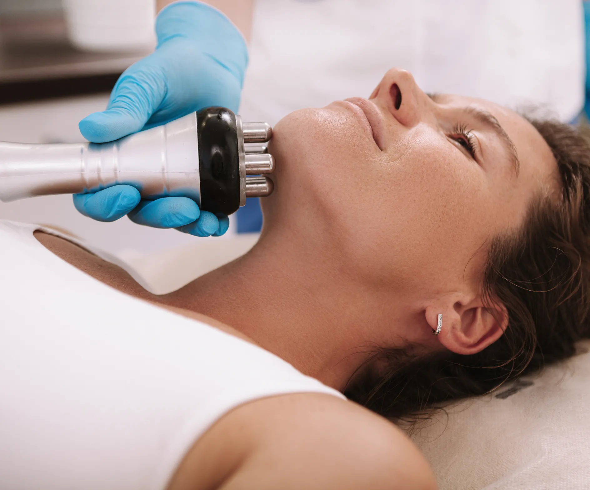 XERF™ benefits for patients at New Wave Dermatology in Newport Beach