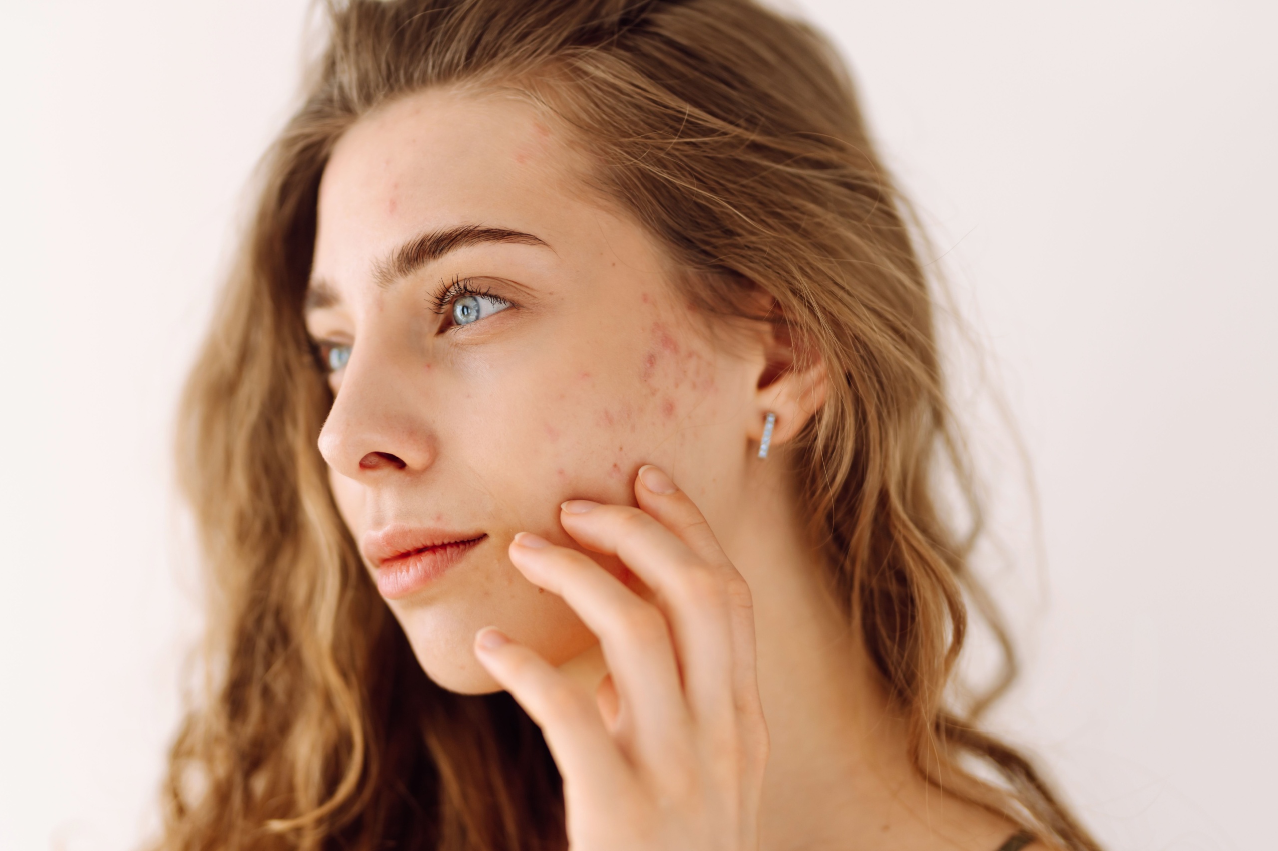 Best Acne Scar Treatments in Newport Beach: Laser, Laser, Lasers Image